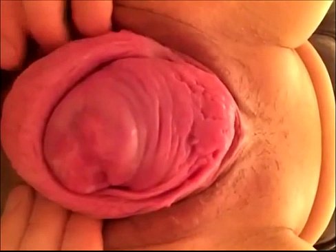 Prolapse vaginal