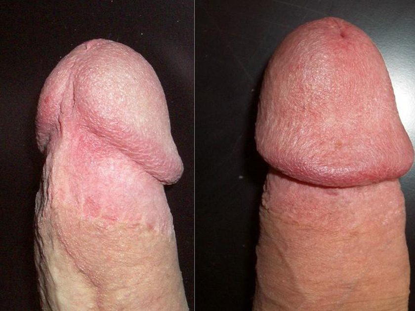best of Dick circumcised
